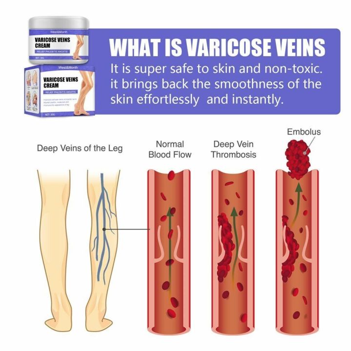 ครีมซ่อมแซมที่มีประสิทธิภาพบรรเทาอาการกระพุ้งขาเครื่องมือการดูแลผิวเส้นเลือดขอดที่เท้าเครื่องมือดูแลเท้าดูแลขา-vasculitis-phlebitis-ลบเส้นเลือดเส้นเลือดดำ