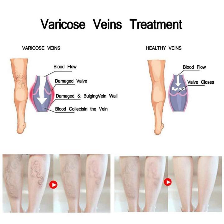 vova-ครีมเส้นเลือดขอดที่เท้าครีมรักษาที่มีประสิทธิภาพความงาม-vasculitis-สมุนไพรจีน-phlebitis-ที่ดูแลผิวที่ขา