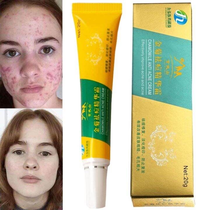 Chamomile Effective Acne Removal Cream Skin Care Acne Treatment Facial