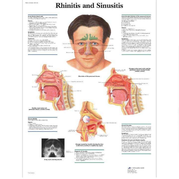 sell-well-rhinitis-ไซนัสอักเสบอุปกรณ์การรักษานวดจมูก-cure-treatment-ไข้ละอองฟางต่ำความถี่เลเซอร์พัลส์-therapy-ไม่มี-bionase-โลโก้