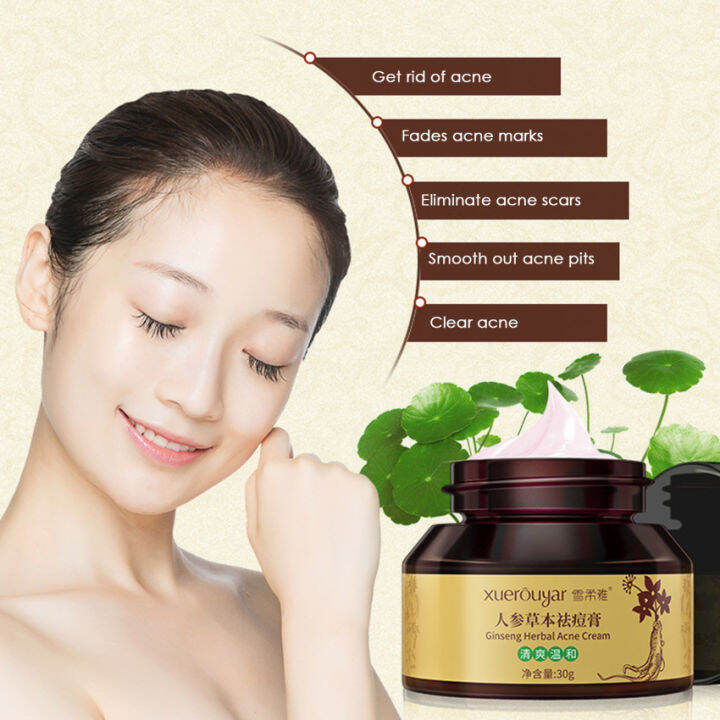 Ginseng Herbal Acne Cream Fades Acne Marks Remove Acne Oil Control ...