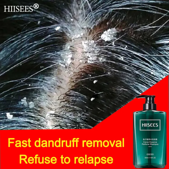 dandruff removal