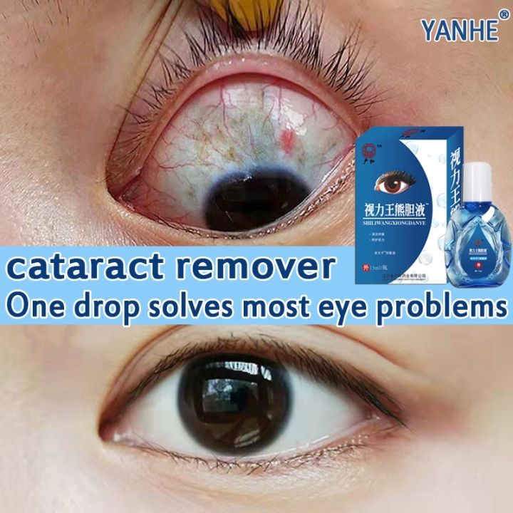 eye drops for cataract original patak sa mata remover healthy care from ...