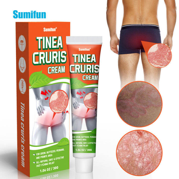 Tinea Cruris Cream 30g Groin Peri Stigmata Pimple Skin Rash