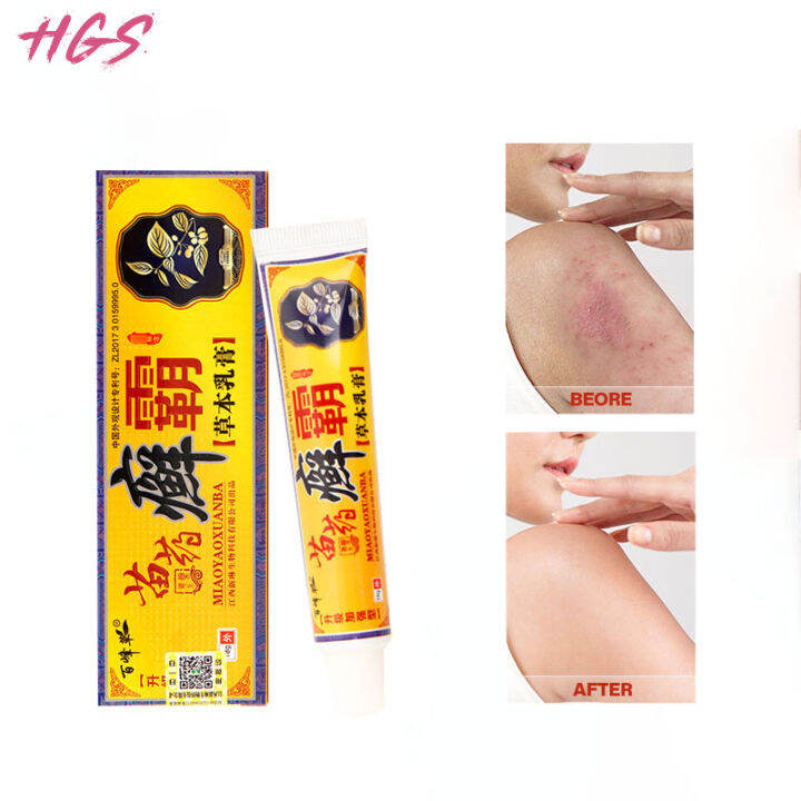 Hgs 15g Antibacterial Psoriasis Cream Herbal Treatment Eczema Relief