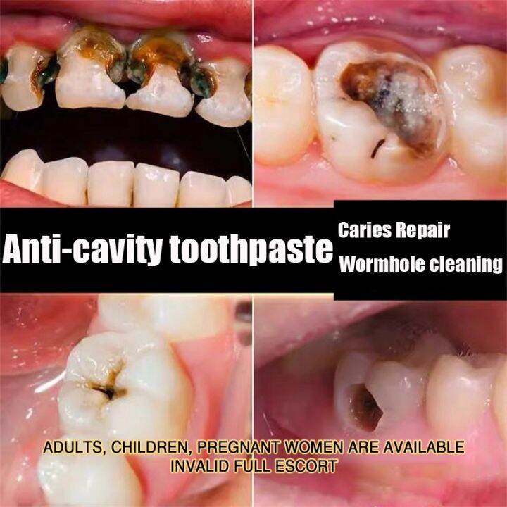 【COD】Antidecay toothpaste 100g toothpaste Quick teeth whitening