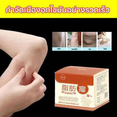 Lipoma removal cream ครีมก้อนเนื้องอกไขมัน สมุนไพรกำจัด ก้อนเนื้อใต้ผิวหนัง ก้อนซีสต์ 30g ก้อนไขมันแข็ง เนื้องอกไขมัน