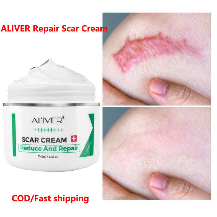 Original ALIVER Scar Repair Cream for old scar on leg stretch mark