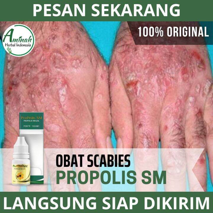 Obat Scabies Obat Gatal Scabies Obat Luka Scabies Obat Scabies Bernanah ...