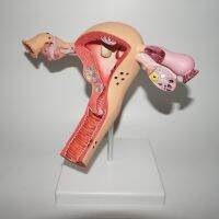 High Quality Human Uterus And Ovary Pathology Model