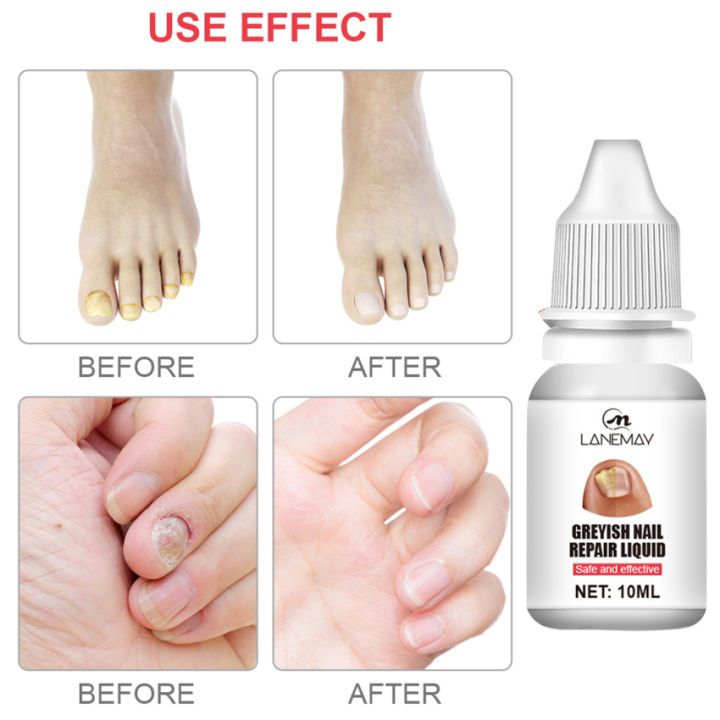 สารสกัดจากเชื้อราที่เล็บเล็บเท้าเท้าดูแลป้องกันการติดเชื้อผลิตภัณฑ์เจลกำจัดเชื้อราเล็บ-paronychia