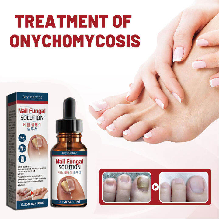 Idun Nail Treatment Fungal Essence Nail Repair Nail Cuticle Care