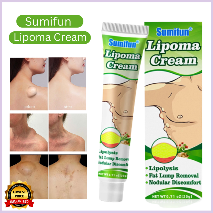 100 Authentic Sumifun Lipoma Removal Cream Treat Tumor Skin Swelling Ointment Herbal 20g Lipoma 