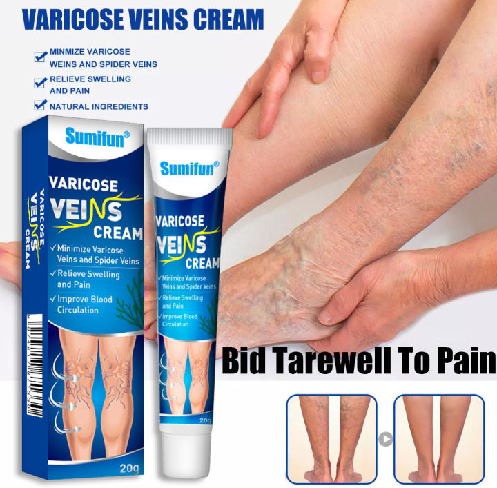 Sumifun Varicose Veins Treatment Cream Phlebitis Varicosity Angiitis ...