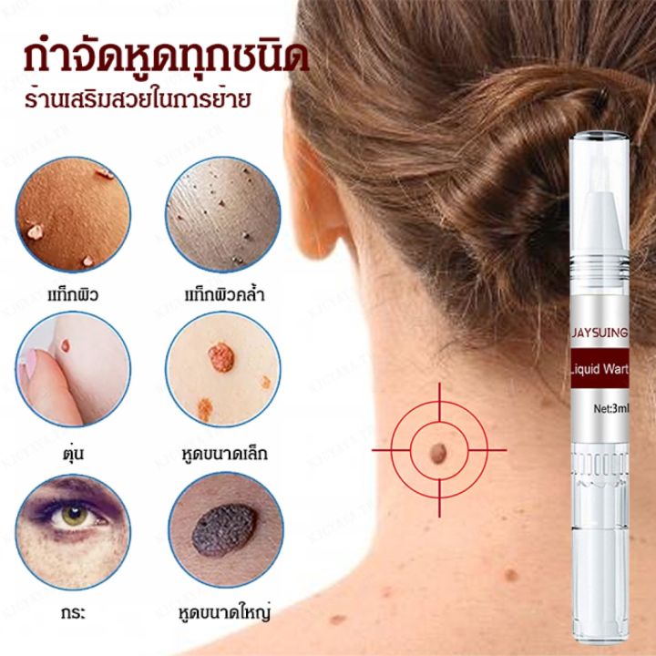 พร้อมส่ง-ยาแต้มหูด-ลอกหูดตาปลา-ขจัดติ่งเนื้อ-หูดข้าวสุก-ที่จี้ไฝ-ไม่ทิ้งร่องรอยปลอดภัยไม่เจ็บตัว-wart-removal-mole-remedy-liquid-pen