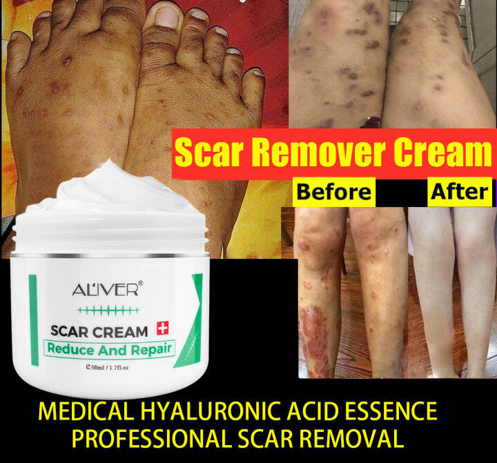 ALIVER Cream for Peklat 50ml , Repair Skin Care Stretch marks, Burn