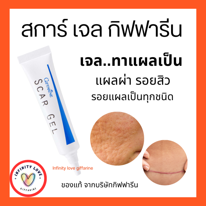 ส่งฟรี-สการ์-เจล-กิฟฟารีน-scar-gel-จัดการแผลเป็น-รอยสิว-รอยแผลเป็น-ทุกชนิดเจลบำรุงผิวสูตรพิเศษ