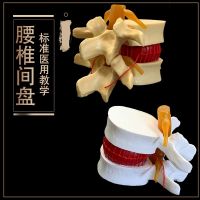 Human pathological lumbar spine pathological model disc human lumbar spine with pathological changes of intervertebral disc model