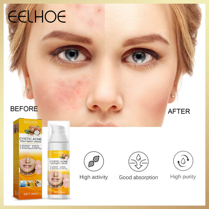 Eelhoe Cystic Acne Treatment Cream Acne Removal Face Cream Oil Control ...