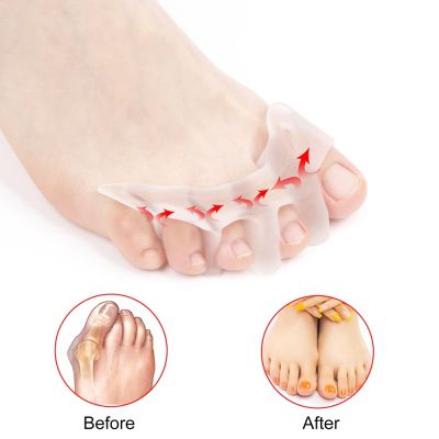 ❃☈♝ Toe Orthopedic Supplies Gel Toe Separator Stretcher for Dancer Yogis Athlete Bunion Relief Hammer Claw Crooked Toes Straightener