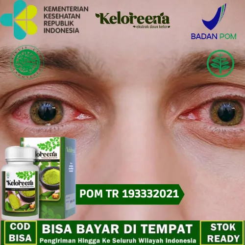 Obat Radang Kelopak Mata, Obat Kulit Mata Bengkak, Obat Untuk Kelopak ...