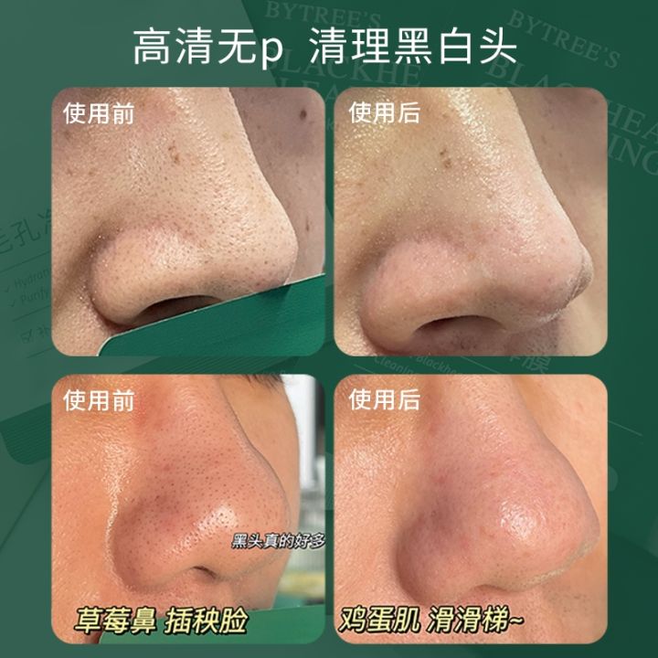 blackhead-harvester-bai-cuisi-go-nose-sticker-box-acne-export-liquid-deep-clean-shrink-pores