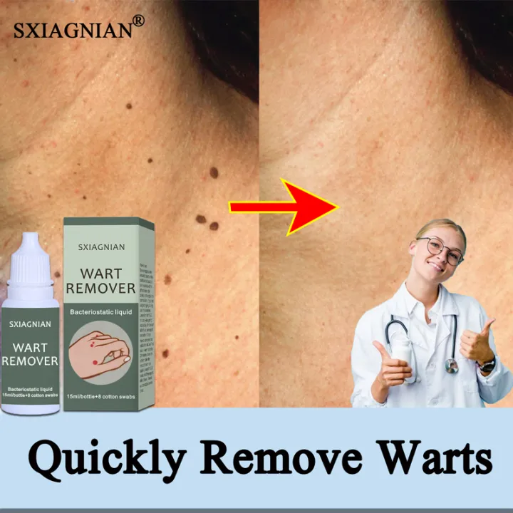 100 EFFECTIVE! SXIAGNIAN Wart Remover, Warts Removal Serum Wart