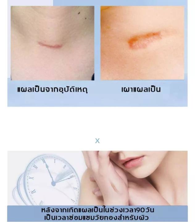 ครีมลดแผลเป็น-ครีมทาแผลเป็น-ลดรอยแผลเปน-แผลไฟไหม้-น้ำร้อนลวก-ซ่อมแซมผิวที่เสียหาย-ลดรอยแผลเปน-ลดรอยเเผลเป็น-ครีมลดรอยแผลเป็น-ครีมลดรอยแผลเป็-น้ำลดรอยแผลเป็น-ครีมทาแผลเป็น-ลดรอยแผลเปน-แผ่นแปะแผลเป็น