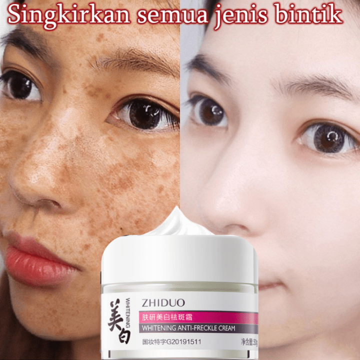 Freckle Cream 50G Remove Dark Spots on Face Melasma and Pekas Remover
