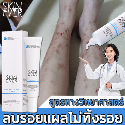 SKINEVER ครีมทาแผลเป็น ครีมแก้ขาลาย ลบรอยแผลเปน ลดรอยเเผลเป็น ​เหมาะสำหรับผิวรอยแตกลาย น้ำร้อนลวก แผลผ่าตัด แผลเป็นจากยุงกัด ยาแก้ขาลาย ครีมลบรอยแผลดำ ยาทาขาลาย ครีมลดรอยแผลดำ ครีมทารอยแผลเป็น ครีมลดรอยแผลเป็น scar gel