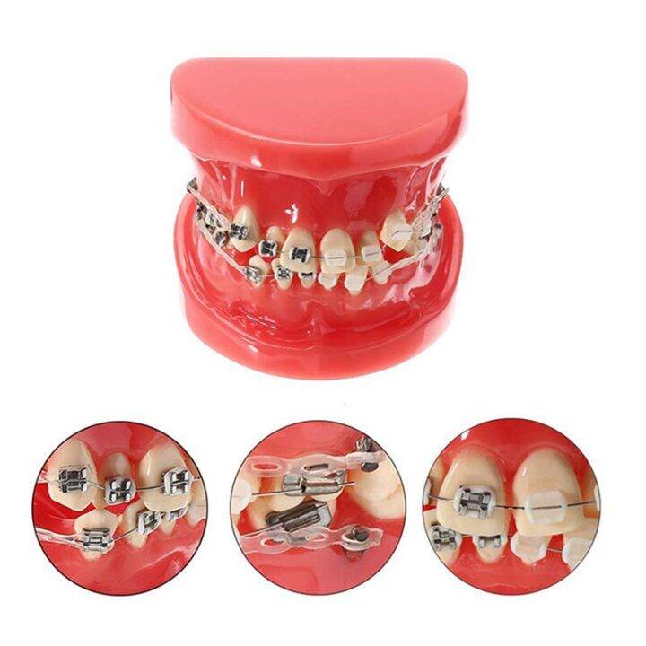 Dentist Orthodontic Treatment Model With Ceramic Metal Bracket Resin