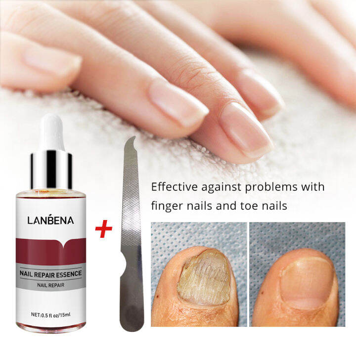 lanbena-nail-repair-essence-serum-nail-treatment-ลบเชื้อรา-onychomycosis-toe-brighten-nourishing-hand-foot-skin-care-12ml