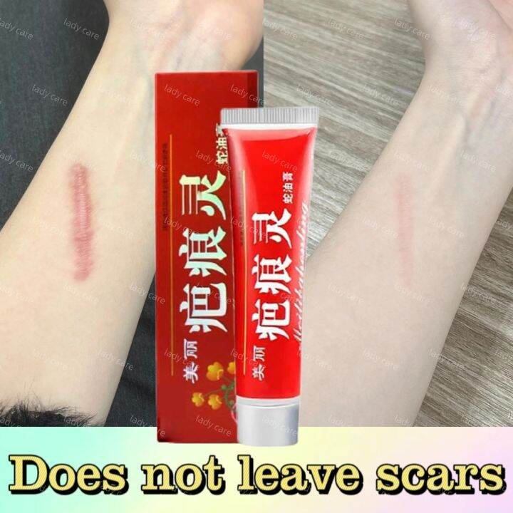 Original Scar Remover for Old Scar on Leg Scar Gel It is easy to