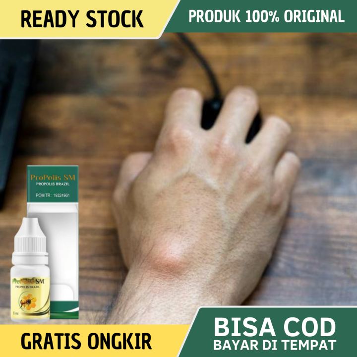 Obat Kista Ganglion, Obat Penghancur Benjolan Ganglion, Obat Benjolan ...