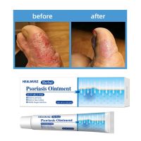 【CW】 Effective Eczema Rash Urticaria Herbal Anti-itch Desquamation Antibacterial Psoriasis Ointment