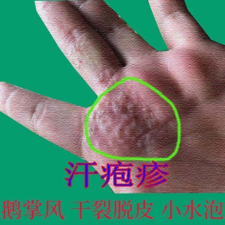 Sweat herpes, small blisters on hands, itchy hands, peeling, cracked