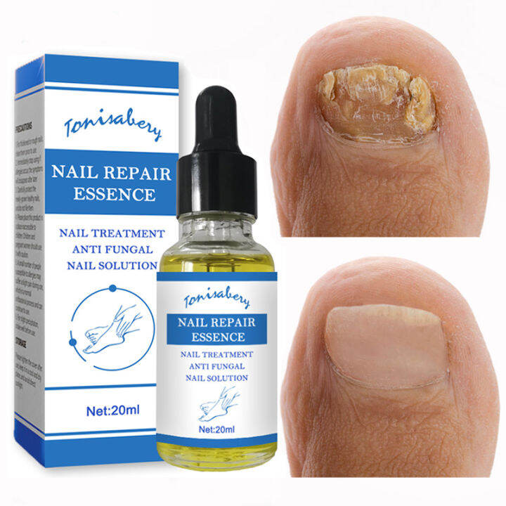 Nail Fungal Treatment Feet Care Essence Nail Foot Care Toe Nail Fungus