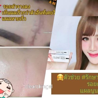 ครีมรักษาแผลเป็น สูตรเข้มข้น ขนาด 7 กรัม scar gel  มีรีวิว