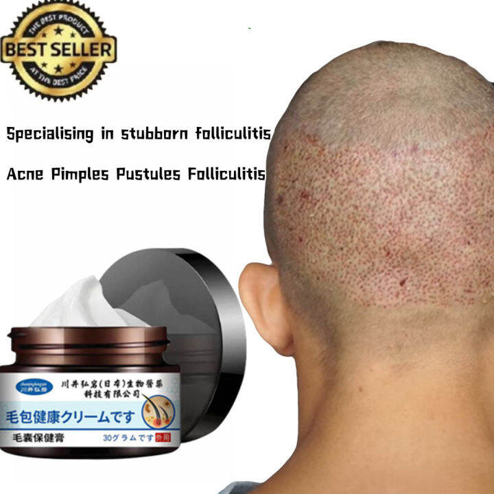 Hair Follicle Cream Treat Scalp Hair Folliculitis Skin Inflammation