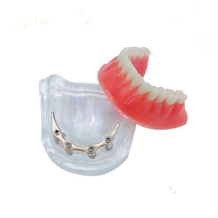 overdenture-implant-model-denture-teeth-mandibular-model-with-golden-bar-dental-teaching-model