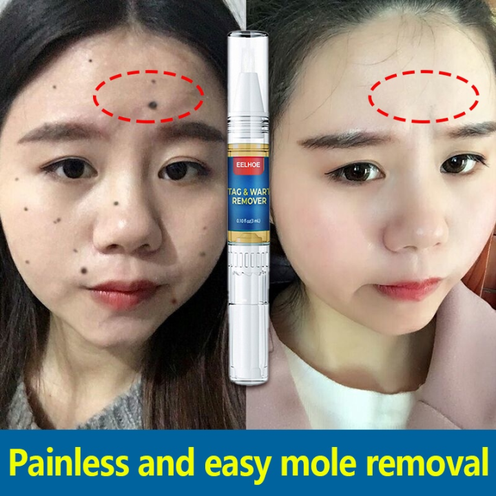 EELHOE Wart and Mole Remover Foot Corn Plantar Wart Papillomas Removal