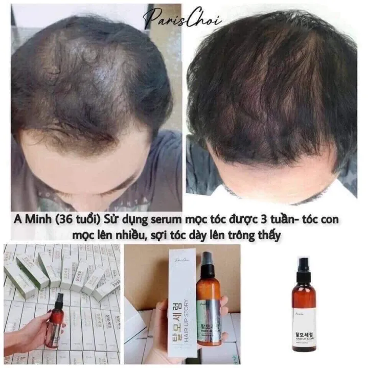 Tri hói đầu - Serum xịt mọc tóc Hair Up Genie Hàn Quốc | Lazada.vn