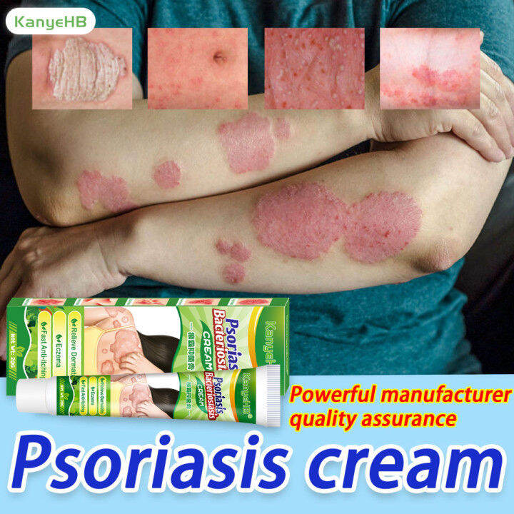 Original Psoriasis Eczema Ointment 20g Treatment moisturizer Cream