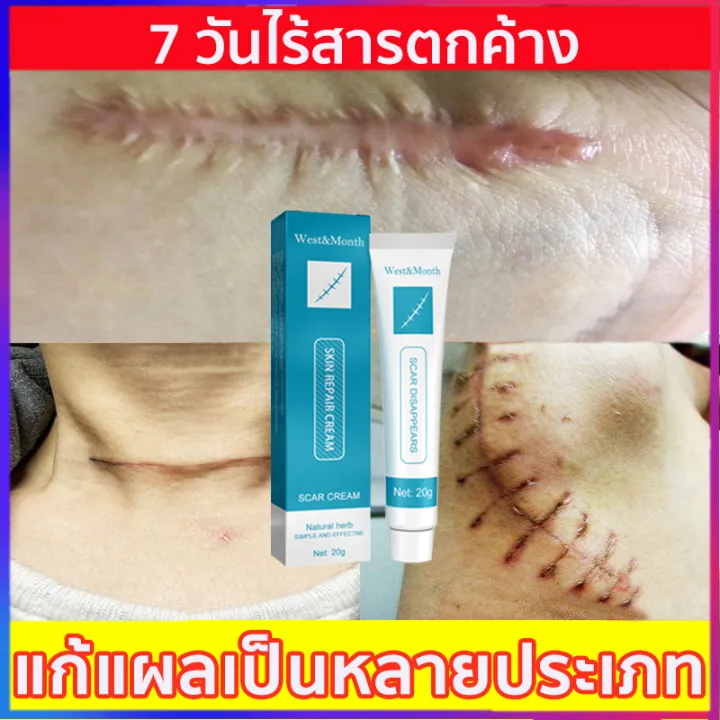 ปรับปรุงรอยแผลเป็น ซ่อมแซมผิวที่เสียหาย ครีมลบแผลเป็น ครีมลดรอยแผล ยารักษาแผลเป็น ยาทาแผลเป็นนูน