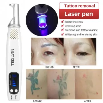 Laser Tattoo Removal in Accra Metropolitan - Other Services, Trusty Herbal  Clinic | Tonaton.com