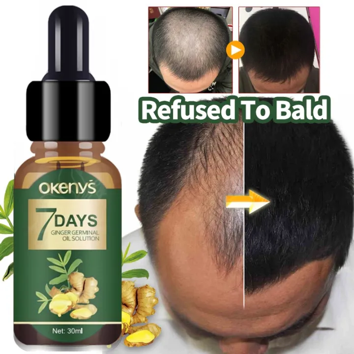 Okeny's Ginger Hair Growth Serum 7 DAY Rapid Grower Hair Treatment Essence  Anti Hair Loss Hair Care | Lazada PH