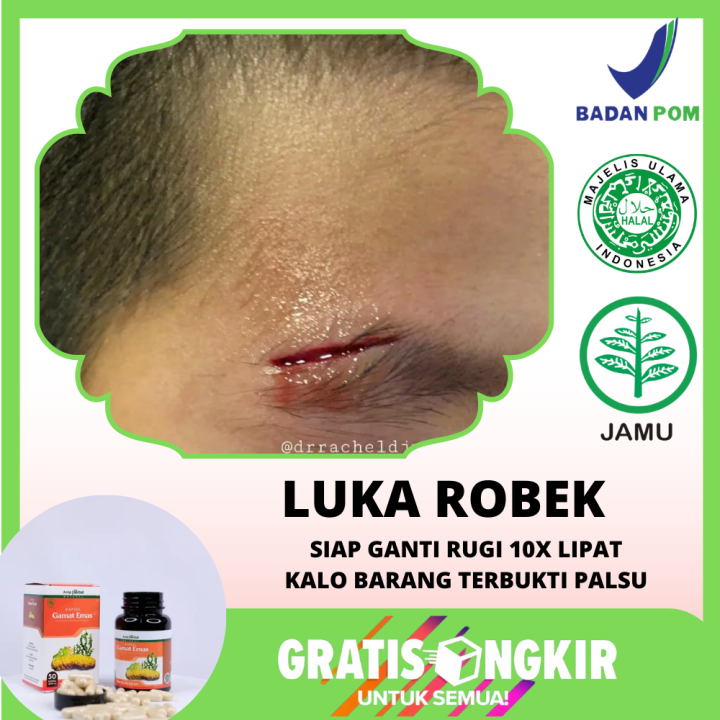 Obat Perapat Luka Robek, Untuk Merapatkan Luka Robek Tanpa Di Jahit