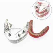 Jiayi Dental Model With Implant Overdenture Inferior Demo Teeth Model