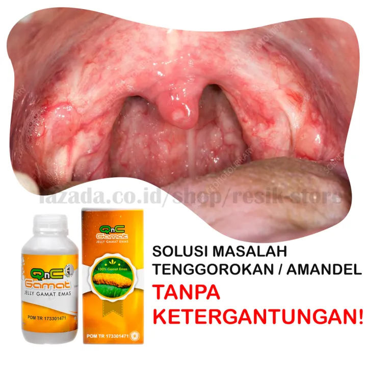 tonsil bengkak dewasa