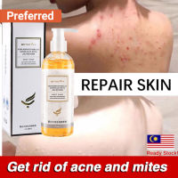 Acne body wash ubat jerawat badan Whitening sabun hilangkan badan Whitening Shower Gel men women Remove chicken skin mites back acne moisturizing body wash for sensitive skin (260ml)痘痘沐浴露